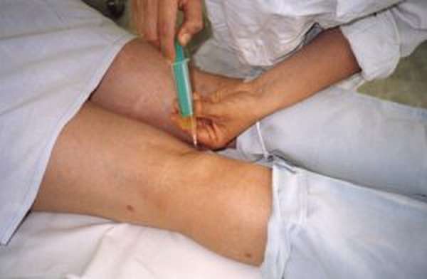 Операция по удалению кисты в коленном суставе